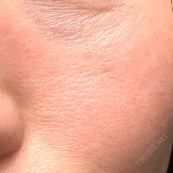 RF（高周波）たるみ治療 湘南美容クリニック 広島院 DAY 7 メイン用