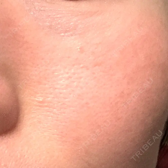 RF（高周波）たるみ治療 湘南美容クリニック 広島院 DAY 8 メイン用