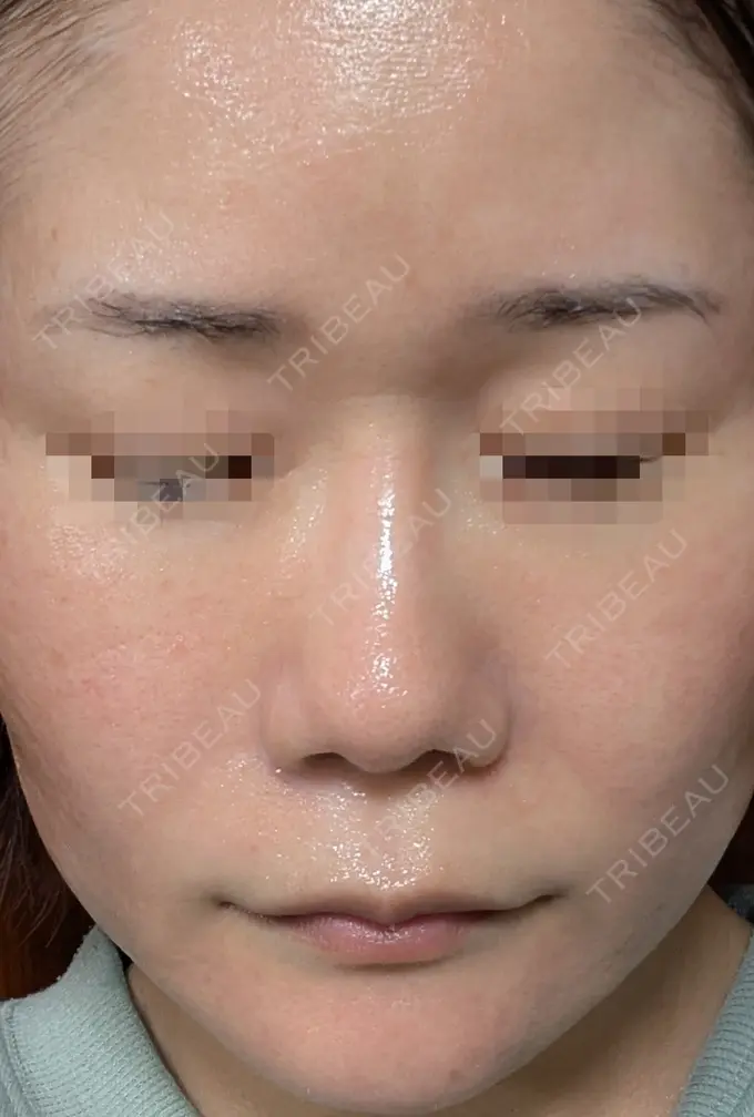 水光注射（ハリ・美肌） / ピーリング（ニキビ・毛穴） / ピーリング（ハリ・ツヤ） DAILY SKIN CLINIC 心斎橋院 DAY 10 メイン用