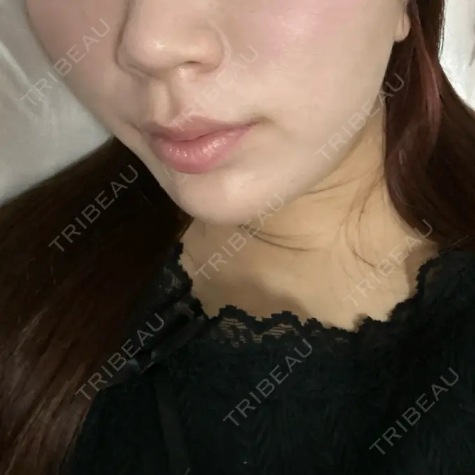 RF（高周波）たるみ治療 大美会クリニック 心斎橋本院 AFTER メイン用