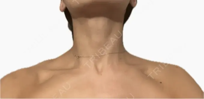 ボトックス（肩） / ボトックス（首） アールクリニック DAY 5 メイン用