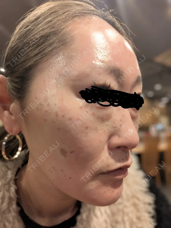 ピコレーザートーニング（美白・肝斑） / ピコフラクショナルレーザー（毛穴・ニキビ跡） / ピコスポット 東京シルククリニック 東京神田院 DAY 0 メイン用