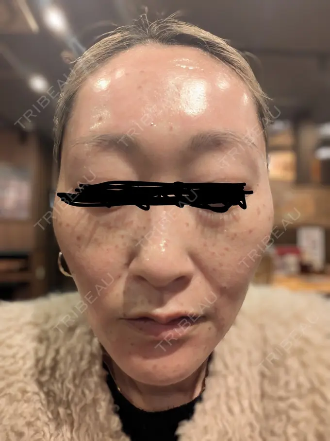 ピコレーザートーニング（美白・肝斑） / ピコフラクショナルレーザー（毛穴・ニキビ跡） / ピコスポット 東京シルククリニック 東京神田院 DAY 0 メイン用