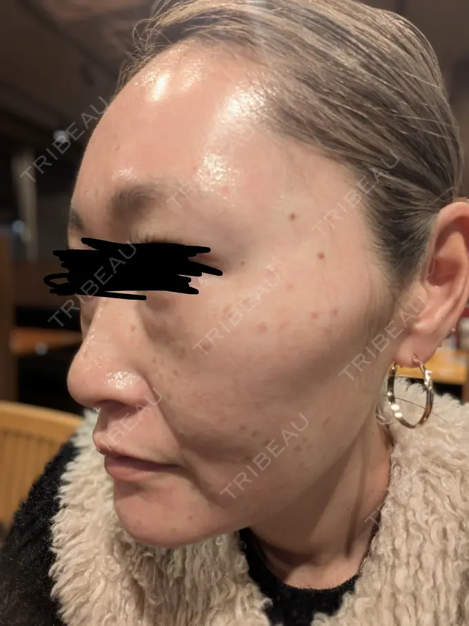 ピコレーザートーニング（美白・肝斑） / ピコフラクショナルレーザー（毛穴・ニキビ跡） / ピコスポット 東京シルククリニック 東京神田院 AFTER メイン用