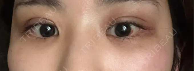 二重埋没 WOM CLINIC GINZA （ワム クリニック ギンザ） AFTER メイン用