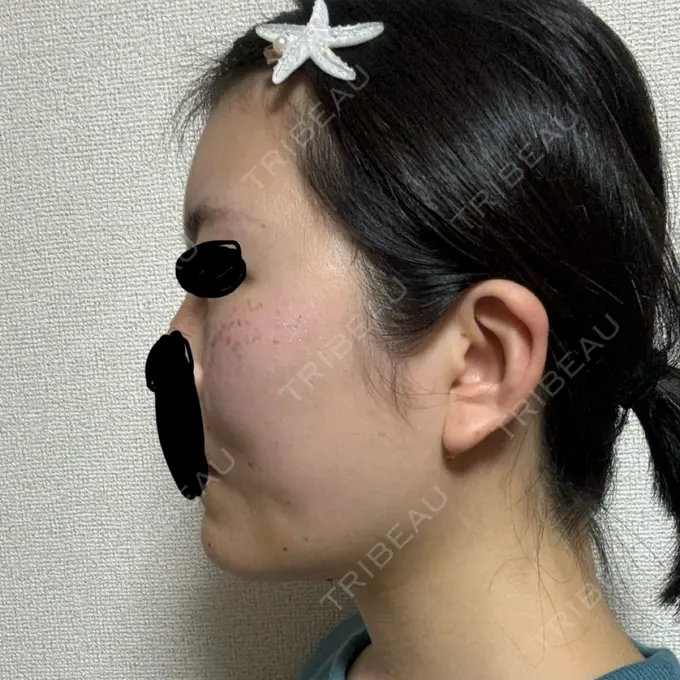 糸リフト / 脂肪吸引（顔） 東京ココセランクリニック DAY 18 メイン用