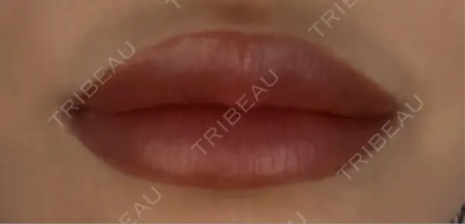 ヒアルロン酸注入（唇） 麻布十番クレールデンタルクリニック DAY 5 メイン用