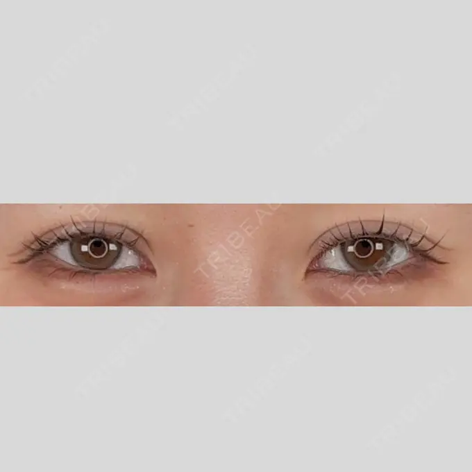 二重埋没 アリエル美容クリニック 水戸院 DAY 9 メイン用