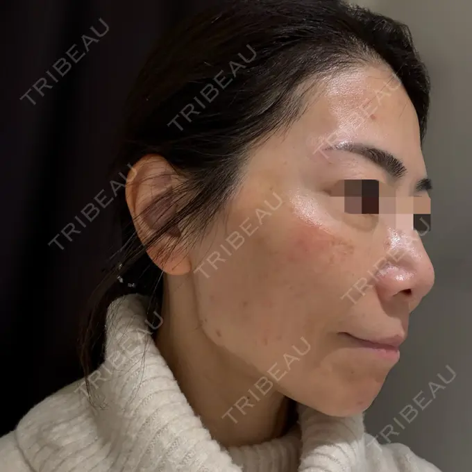 美肌レーザー / 美白レーザー / ピコレーザートーニング（美白・肝斑） / レーザートーニング（美白・肝斑） 銀座みゆき通り美容外科 大阪梅田院 DAY 0 メイン用