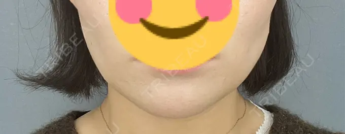 糸リフト / 脂肪吸引（顔） / 脂肪吸引注射（顔） ziz CLINIC AFTER メイン用