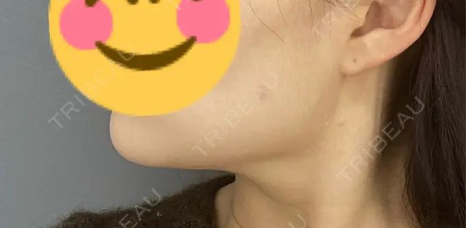 糸リフト / 脂肪吸引（顔） / 脂肪吸引注射（顔） ziz CLINIC DAY 93 メイン用