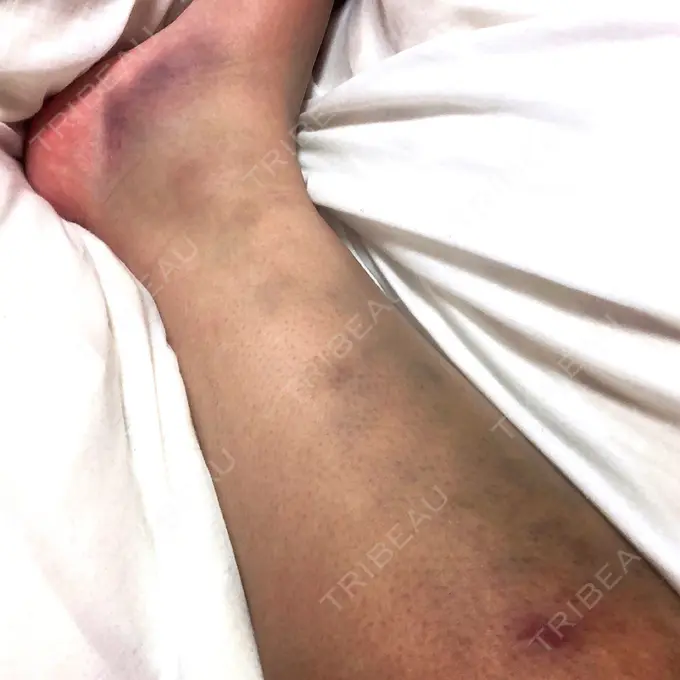 脂肪吸引（脚） THE CLINIC（ザ・クリニック） 名古屋院 DAY 10 メイン用