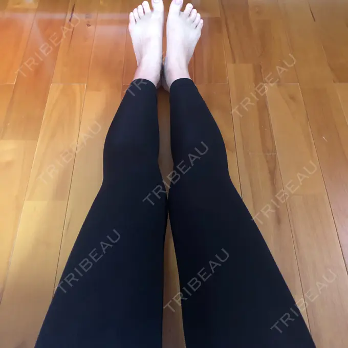 脂肪吸引（脚） THE CLINIC（ザ・クリニック） 名古屋院 DAY 14 メイン用