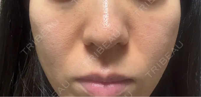 ジャルプロ 城本クリニック 静岡院 DAY 7 メイン用