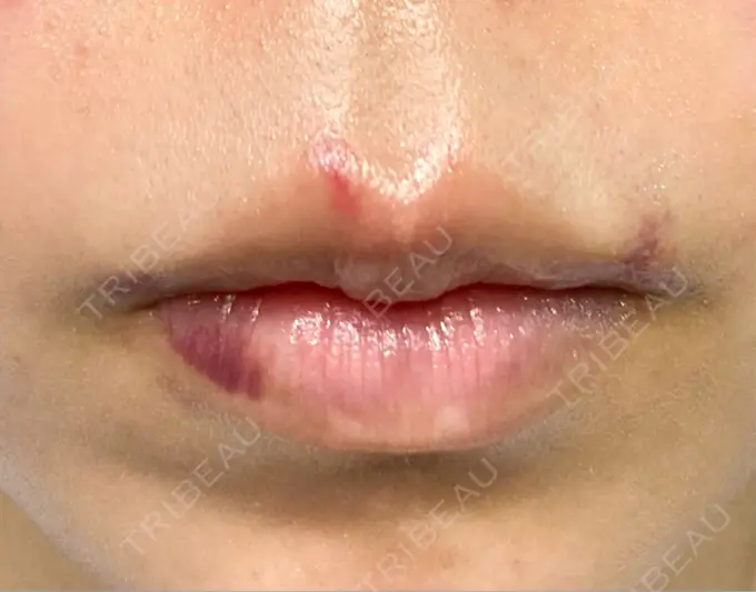 ヒアルロン酸注入（唇） HAAB×DREAM BEAUTY CLINIC 大阪梅田院 DAY 2 メイン用