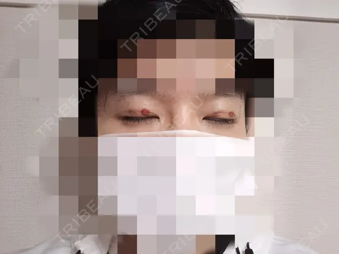 目元修正 もとび美容外科クリニック 新宿院 DAY 0 メイン用