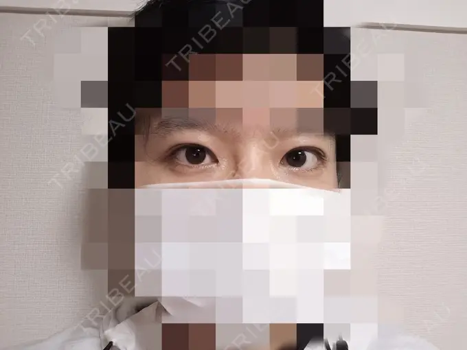 目元修正 もとび美容外科クリニック 新宿院 DAY 0 メイン用