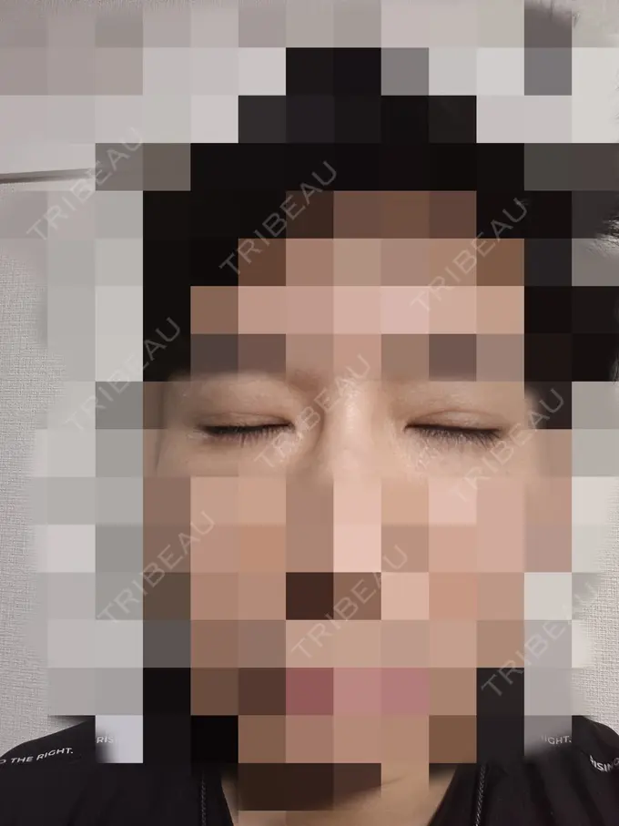 目元修正 もとび美容外科クリニック 新宿院 DAY 9 メイン用