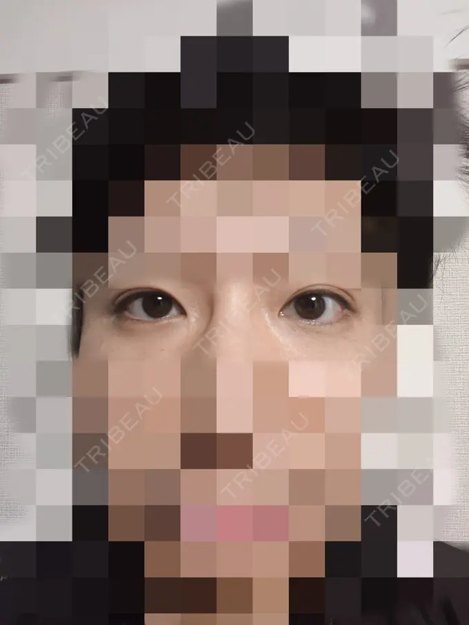 目元修正 もとび美容外科クリニック 新宿院 AFTER メイン用