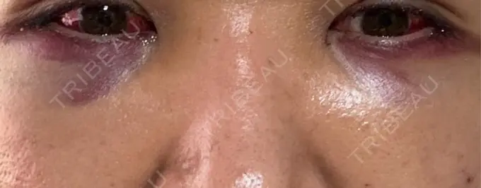 クマ治療 藤・ナチュレ美容クリニック 銀座院 DAY 1 メイン用