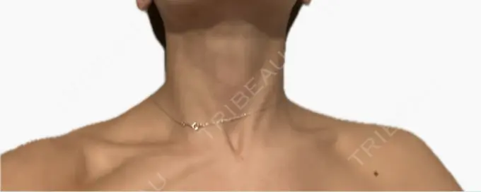 ボトックス（肩） / ボトックス（首） アールクリニック DAY 6 メイン用