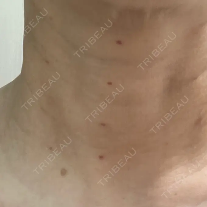 ジャルプロ ゆきスキンクリニック 東池袋 AFTER メイン用