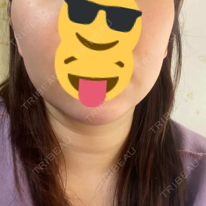 ボトックス（あご） / ヒアルロン酸注入（あご） / ハイフ（顔） / RF（高周波）たるみ治療 ルラ美容クリニック 名古屋栄院 / ルラスキンクリニック 名古屋栄院 DAY 0 メイン用