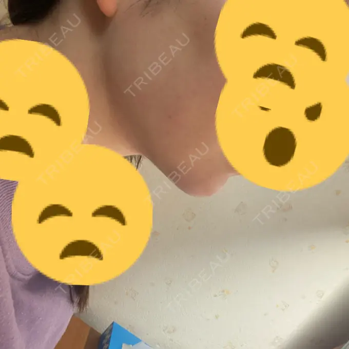 ボトックス（あご） / ヒアルロン酸注入（あご） / ハイフ（顔） / RF（高周波）たるみ治療 ルラ美容クリニック 名古屋栄院 / ルラスキンクリニック 名古屋栄院 DAY 0 メイン用