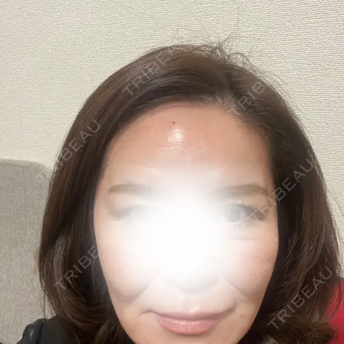 肌ヒアルロン酸注入（たるみ・シワ改善） 城本クリニック 新宿院 AFTER メイン用