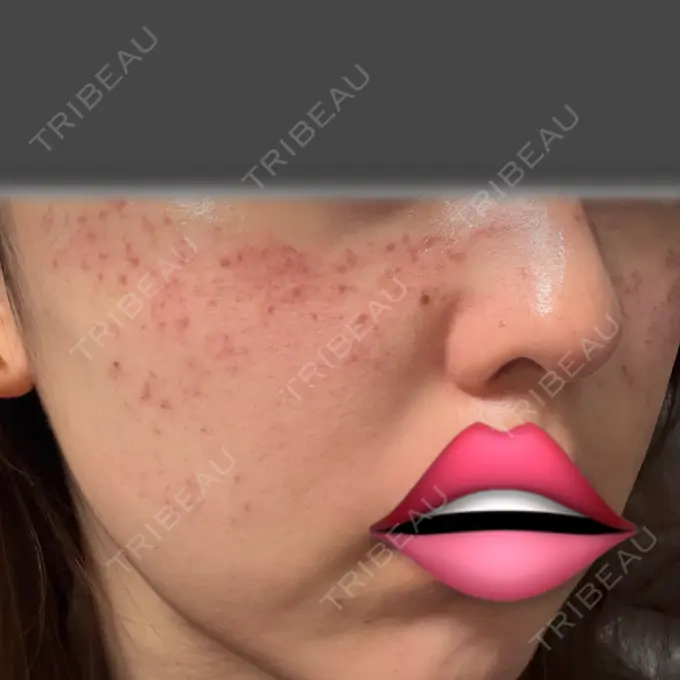 ピコスポット 東京シルククリニック 新宿院 AFTER メイン用