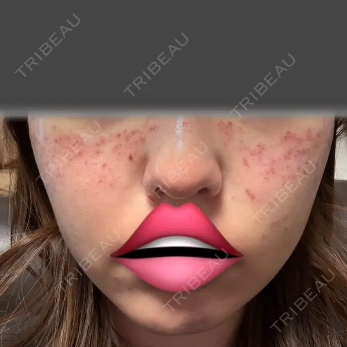 ピコスポット 東京シルククリニック 新宿院 DAY 0 メイン用