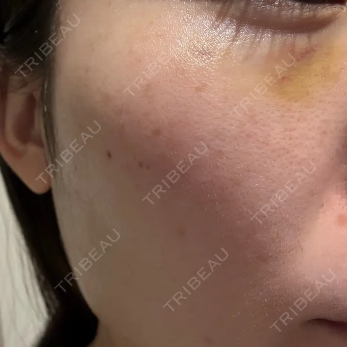 スネコス ルラ美容クリニック 仙台院 / ルラスキンクリニック 仙台院 DAY 4 メイン用