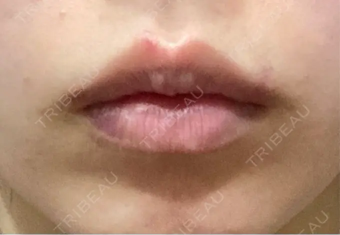 ヒアルロン酸注入（唇） HAAB×DREAM BEAUTY CLINIC 大阪梅田院 DAY 3 メイン用