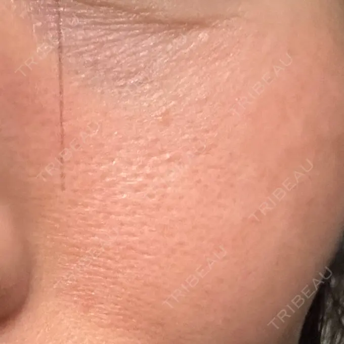 RF（高周波）たるみ治療 湘南美容クリニック 広島院 DAY 9 メイン用