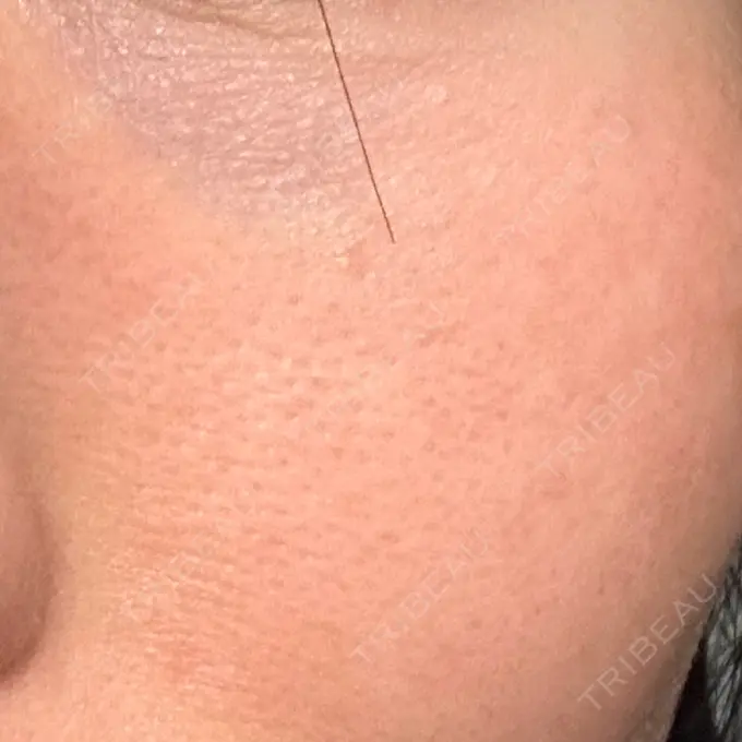 RF（高周波）たるみ治療 湘南美容クリニック 広島院 AFTER メイン用