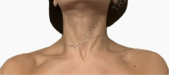 ボトックス（肩） / ボトックス（首） アールクリニック DAY 7 メイン用