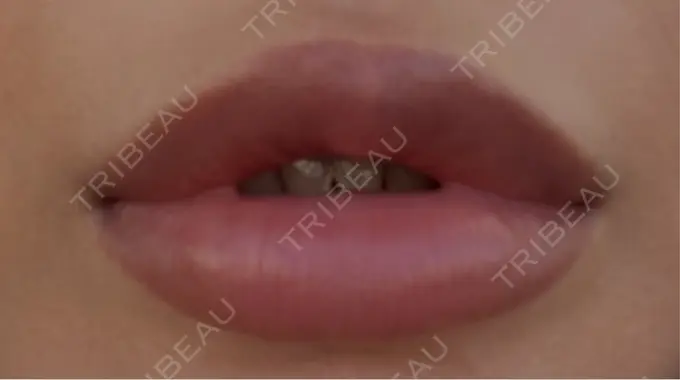 ヒアルロン酸注入（唇） 麻布十番クレールデンタルクリニック AFTER メイン用