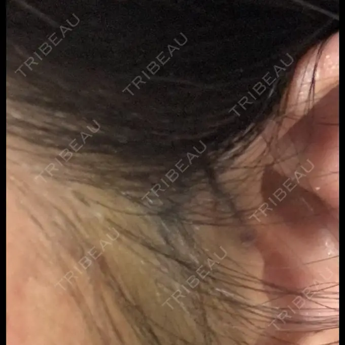 切開リフト GRACY TOKYO CLINIC【グレイシートウキョウクリニック】 DAY 4 メイン用