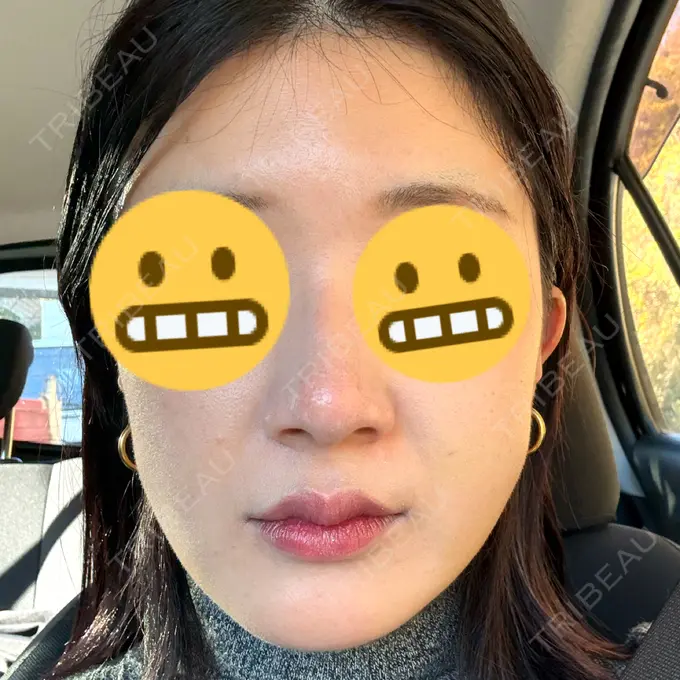 糸リフト / 脂肪吸引（顔） 下北沢スキンクリニック DAY 10 メイン用