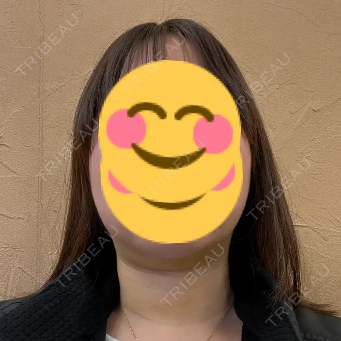 糸リフト / 脂肪吸引注射（顔） APスキンクリニック銀座 DAY 10 メイン用