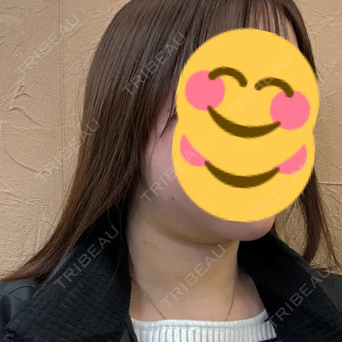 糸リフト / 脂肪吸引注射（顔） APスキンクリニック銀座 DAY 10 メイン用