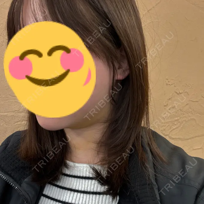 糸リフト / 脂肪吸引注射（顔） APスキンクリニック銀座 DAY 10 メイン用