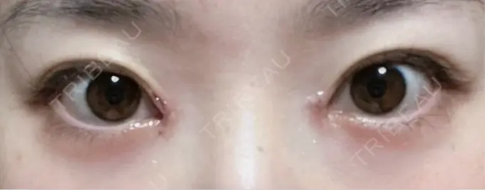 目頭切開 新宿美容外科ネビュラクリニック AFTER メイン用
