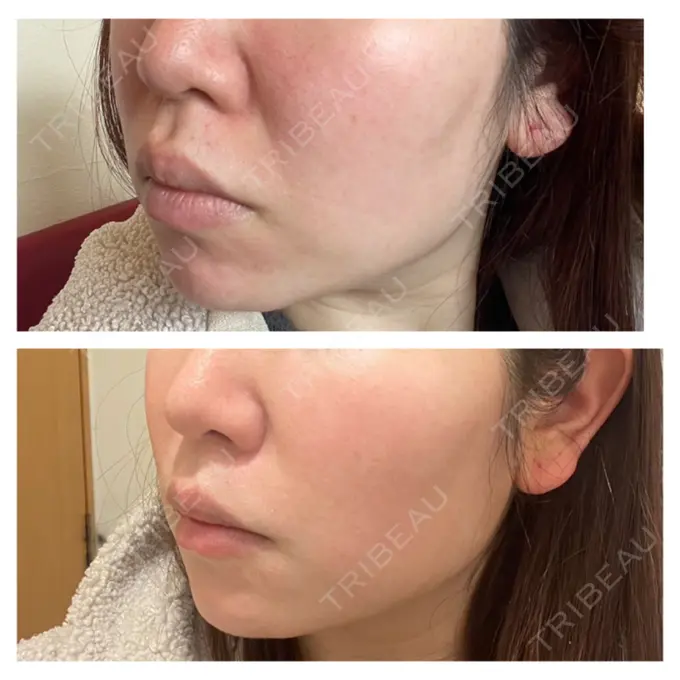 ハイフ（顔） 共立美容外科 福岡院 DAY 0 メイン用