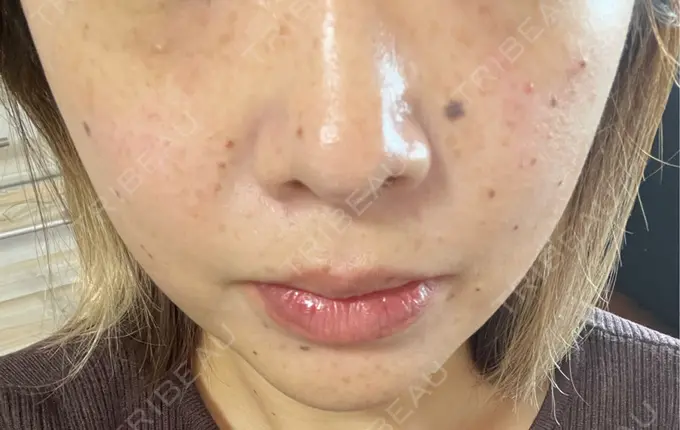 イオン導入 ルラ美容クリニック 千葉院 / ルラスキンクリニック 千葉院 DAY 0 メイン用