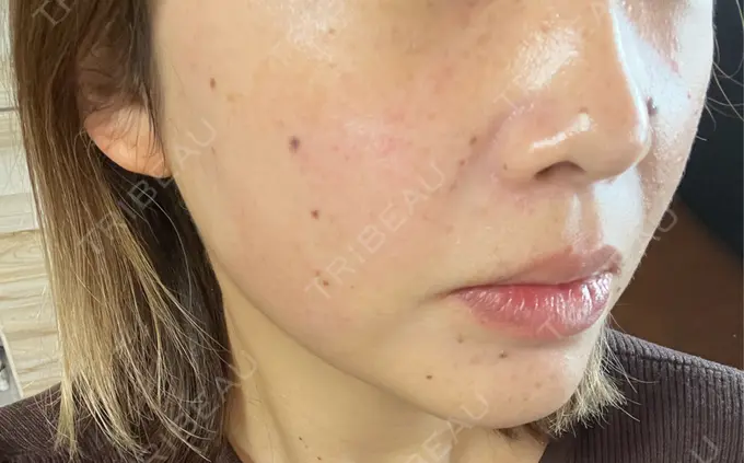 イオン導入 ルラ美容クリニック 千葉院 / ルラスキンクリニック 千葉院 DAY 0 メイン用