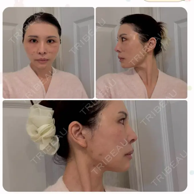 糸リフト / ボトックス（エラ・小顔） / ヒアルロン酸注入（唇） / ヒアルロン酸注入（頬） EMMO FACE CLINIC 東京三田院 AFTER メイン用