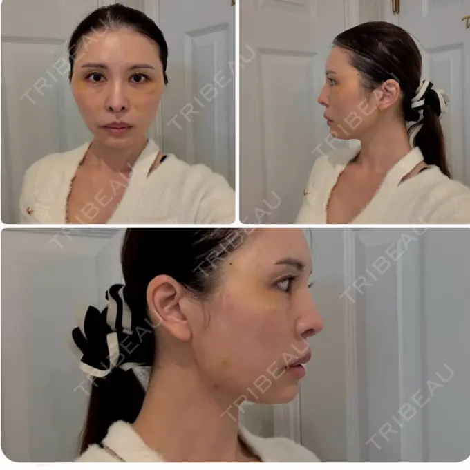 糸リフト / ボトックス（エラ・小顔） / ヒアルロン酸注入（唇） / ヒアルロン酸注入（頬） EMMO FACE CLINIC 東京三田院 DAY 2 メイン用