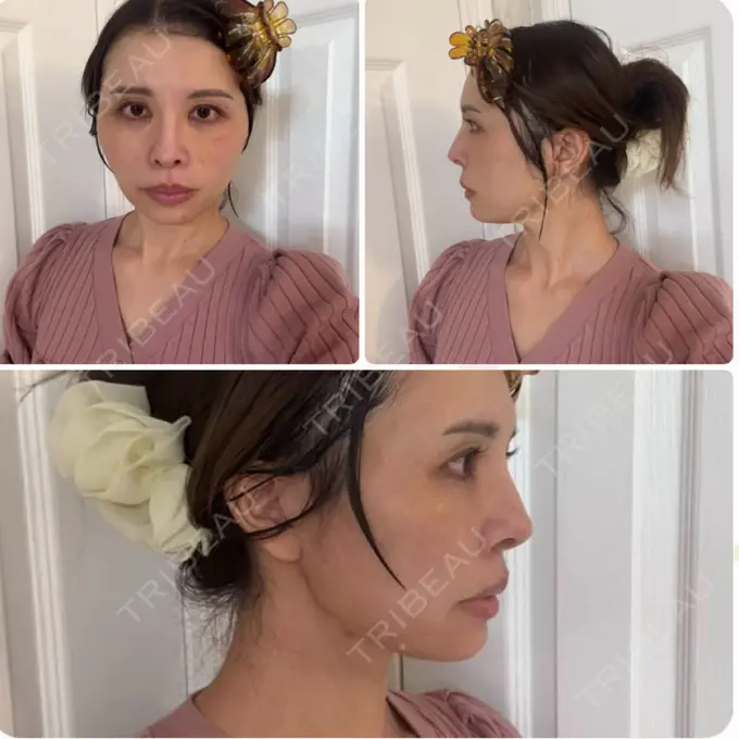 糸リフト / ボトックス（エラ・小顔） / ヒアルロン酸注入（唇） / ヒアルロン酸注入（頬） EMMO FACE CLINIC 東京三田院 DAY 2 メイン用