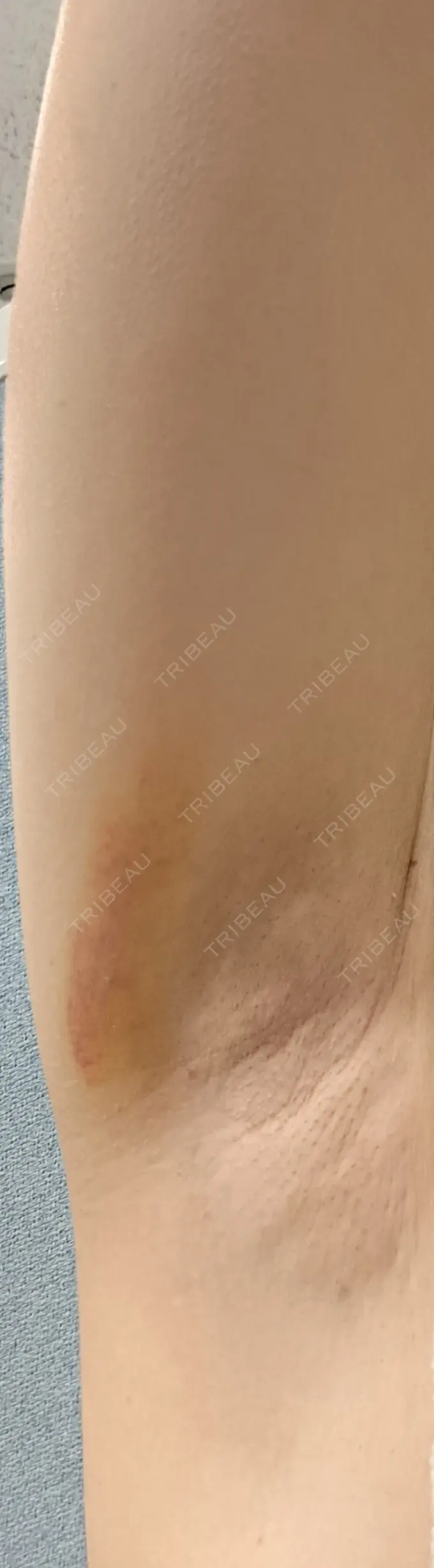 ワキ汗治療（レーザー） フォンタナクリニック天神 DAY 3 メイン用